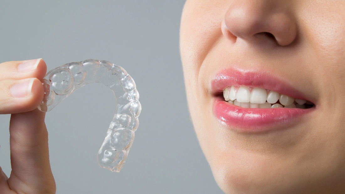 Lake Erie Dental Blog Clear Braces for a Modern Approach to Straight