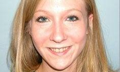 Crowns-Veneers-Before-Image